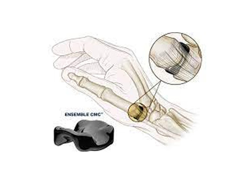 Hyalex Orthopaedics Reports Treatment of First Patients with Novel HYALEX® Knee Cartilage System